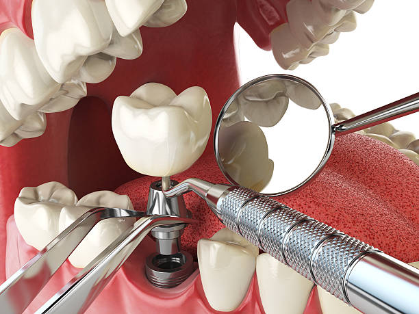Best Emergency Tooth Extraction in Queens Gate, PA